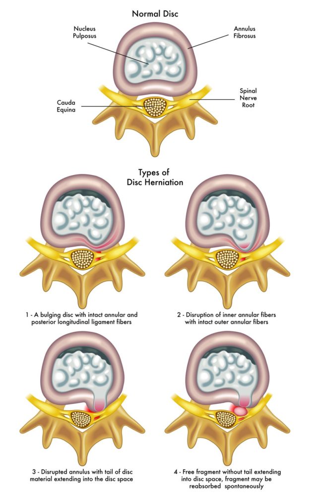 Slipped Disc treatment bedford bedfordshire