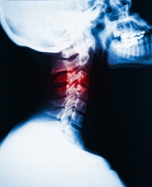 neck pain bedford bedfordshire