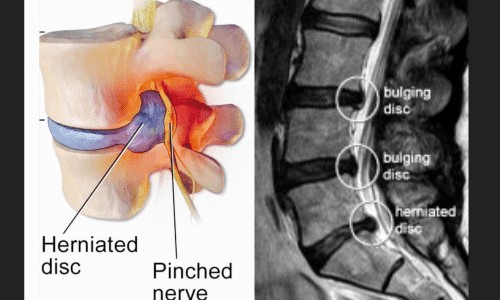 disc pain treatment bedford bedfordshire